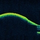 OCT Showing Premacular Hemorrhage OCT Showing Premacular Hemorrhage
