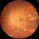 Leukemic Retinopathy and Optic Neuropathy Leukemic Retinopathy and Optic Neuropathy
