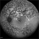 Active Multi Focal Choroiditis Active Multi Focal Choroiditis