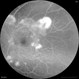 Proliferative Diabetic Retinopathy with Neovascularization