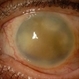 Corneal Decompensation Following Endophthalmitis