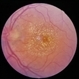 Neuroretinitis Neuroretinitis