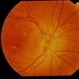 Vitreous Traction on Disc / PVD Vitreous Traction on Disc / PVD