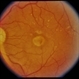 ARMD / Subfoveal CNVM ARMD / Subfoveal CNVM