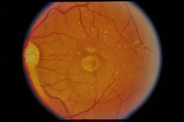 Armd Subfoveal Cnvm Retina Image Bank