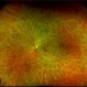 Posterior Ophthalmomyiasis Interna Posterior Ophthalmomyiasis Interna