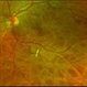 Posterior Ophthalmomyiasis Interna Posterior Ophthalmomyiasis Interna