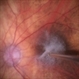 Triamcinilone Stained Posterior Hyaloid Triamcinilone Stained Posterior Hyaloid