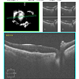 Macular Hole POD 1 OCT Macular Hole POD 1 OCT