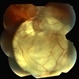 Optic Nerve Coloboma Optic Nerve Coloboma