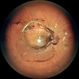 SUB-HYALOID HEMORRHAGE