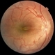Macular Fold Macular Fold