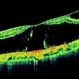 Bilateral Myopic Foveoschisis Bilateral Myopic Foveoschisis