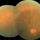 Neovascularisation of Disc