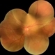 Choroidal-Mass with Exudative Retinal Detachment Choroidal-Mass with Exudative Retinal Detachment