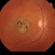 Stargardt's Disease