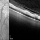 Venous Beading as Seen on OCT Venous Beading as Seen on OCT