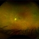 Proliferative Diabetic Retinopathy and SC Disease Proliferative Diabetic Retinopathy and SC Disease