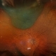 Ciliary Body Melanoma Ciliary Body Melanoma