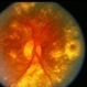CNVM / Cholesterolemia