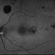 Retinal Microaneurysms & Dot/Blot Hemes Autofluorescence OS Retinal Microaneurysms & Dot/Blot Hemes Autofluorescence OS
