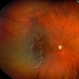 Retinal Detachment with Single Break Retinal Detachment with Single Break