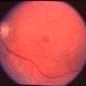 Stargardt's Disease