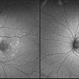 Resolved Multiple Evanescent White Dot Syndrome Resolved Multiple Evanescent White Dot Syndrome