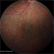 Usher's Syndrome Usher's Syndrome