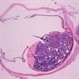 Retinoblastoma