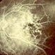 Primary Hyperoxaluria and Oxalosis
