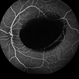 Primary Subhyaloid Hemorrhage Due to Valsalva Retinopathy