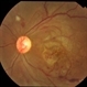 Retinal Vasculopathy