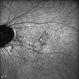 Bruch’s membrane rupture Bruch’s membrane rupture