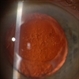 Amyloid Degeneration of the Cornea Amyloid Degeneration of the Cornea
