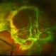 Chronic Total Retinal Detachment Chronic Total Retinal Detachment
