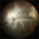 Funnel Retinal Detachment Funnel Retinal Detachment