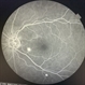 CSR Treated with Focal Laser:  FFA CSR Treated with Focal Laser:  FFA