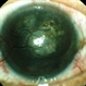 Corneal Vascularisation With Spheroidal Degeneration Corneal Vascularisation With Spheroidal Degeneration