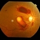 Premacular Hemorrhage in Acute Myeloid Leukemia