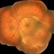 Acute Syphilitic Posterior Placoid Chorioretinitis Acute Syphilitic Posterior Placoid Chorioretinitis
