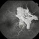 Large Leaking  Optic Disc Neovascularization
