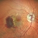 WET AGE RELATED MACULAR DEGENERATION WET AGE RELATED MACULAR DEGENERATION
