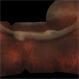 Giant Retinal Tear