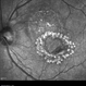 Macular Tear Macular Tear