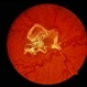Wyburn-Mason Syndrome