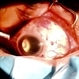 Horseshoe Tear