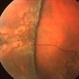 Bullous Retinoschisis status post Scleral Buckle Bullous Retinoschisis status post Scleral Buckle
