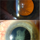 Anterior Capsule Opacification Anterior Capsule Opacification