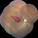 Preretinal Hemorrhage Extending into the Macula Preretinal Hemorrhage Extending into the Macula